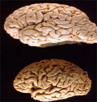 Alzheimer'den korunmak mümkün