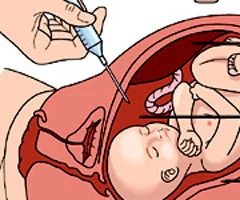 Amniyosentezden daha güvenli test