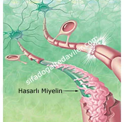MS hastaları için yeni bir umut