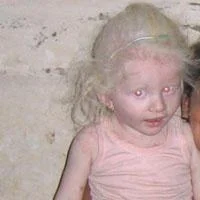 Albino kızın kol ve bacaklarını kopardılar