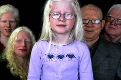 Burundi'de yine albino öldürüldü