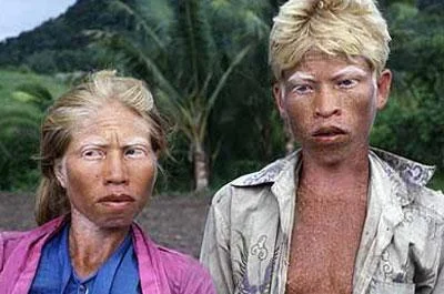 Albino katliamı devam ediyor!