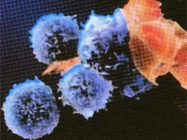 AIDS'le mücadelede 'sünnet' yöntemi
