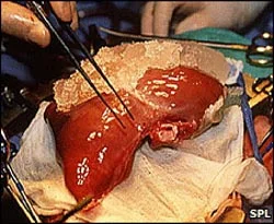 İsrail'de, organ bağışlayana öncelik