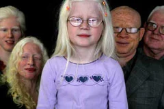 Albino katliamı sürüyor