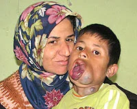 Dudakları sürekli büyüyen çocuk