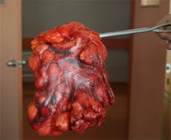 Karnından 11 kilo tümör çıktı