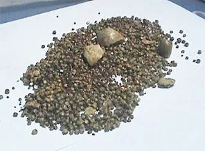 Safra kesesinden 476 taş çıkarıldı