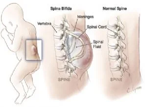 Spina Bifida hastalığına yeni umut