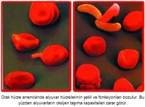 Hücre anemisi hastalarına iyi haber