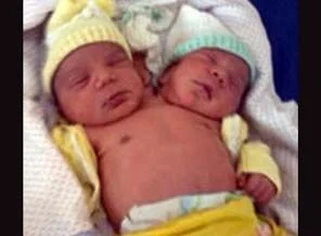İki başlı bebek tek kalpli doğdu