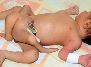 6 bacaklı bebek dünyaya geldi