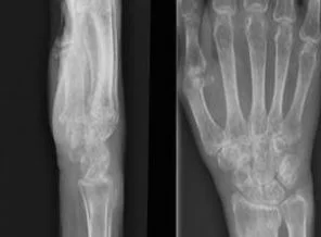 Osteoporoz teşhisinde 'yeni bir yöntem'