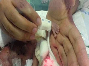 Tam 336 gram doğdu!