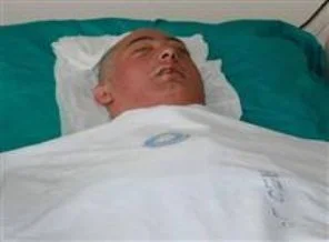Yüz naklinin ilk fotoğrafı
