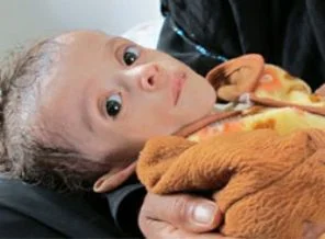 Yemen açlıkla boğuşuyor
