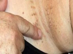 Et beni şeker hastalığının habercisi