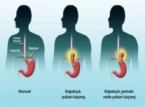 Mide olumsuzlukları hazmedemiyor