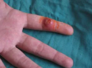 Rusya'da şarbon alarmı: Bir ölü