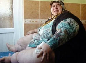 Obezite hastası kadın 260 kiloya ulaştı