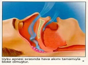 Uyku apnesi kadınlarda erken bunama nedeni