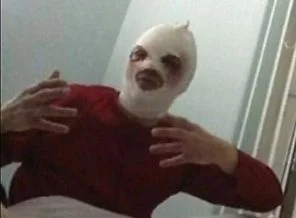 Yüzüne asit atılan Bolşoy'a estetik