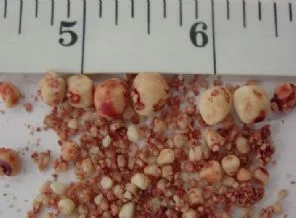 1668 çeşit vücut taşı inceleniyor