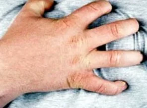 Obezler kalp hastalıklarını hafif geçiriyor