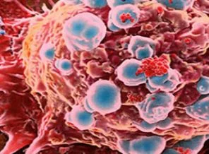 Kanser için 'Mobil' tarama seferberliği