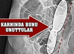 Hastanın karnında unutulana bakın!