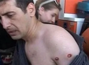 2 gazeteci plastik mermi mağduru