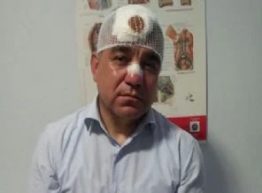 CHP'li Ramis Topal'ın burnu kırıldı