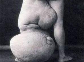 Dünyanın en garip hastalıkları (Foto Galeri)