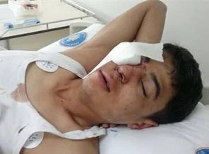 Gaz bombası kapsülü ile gözünü kaybetti