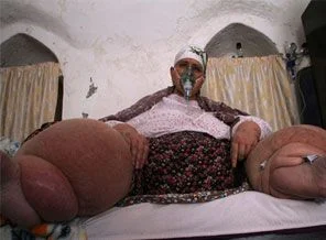 Fil hastalığı yüzünden gün ışığı görmedi