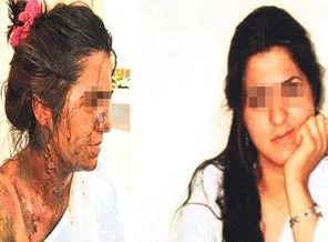 Yüzünü asitle yakan kocası peşinde olan Aysel: Beni kim kurtaracak!