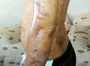 Diyarbakır'da epilasyon faciası