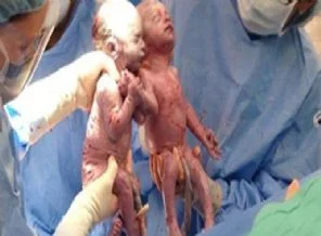 Doktorları duygulandıran doğum!