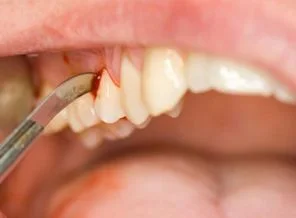 Diş sağlığı ile ilgili 10 yanlış bilgi!