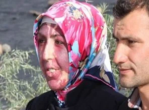 Gelinliğini beyaz yüzüyle giymek istiyor!