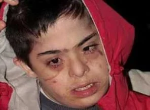 Down sendromlu çocuğa dayak iddiası