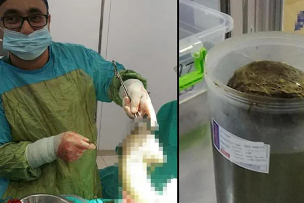 Midesinden 1.5 kilogram saç çıkarıldı