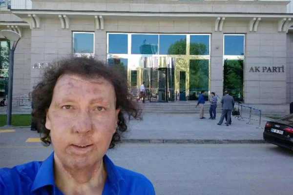 Yüz nakli olan kişi Ak Parti'den aday adayı