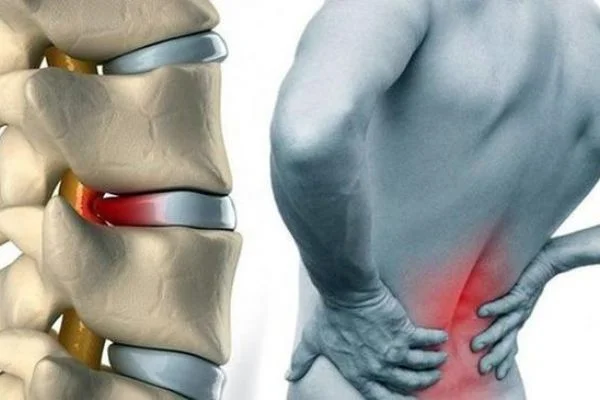 Günlük aktivitelerle şiddetlenen bel ağrıları olanlar dikkat