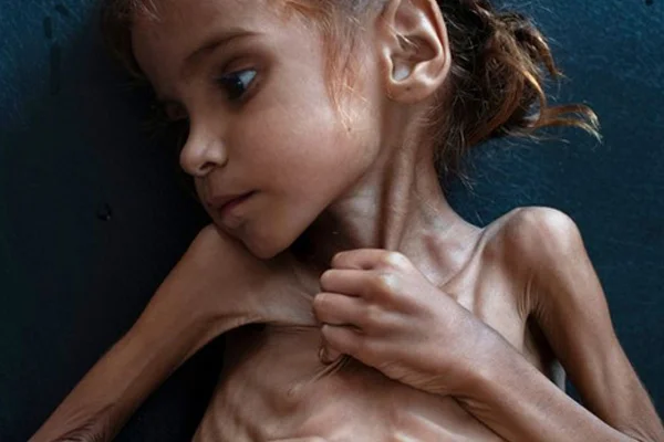Hastaneye gitmesi için para bulunamayan Yemenli Amal vefat etti