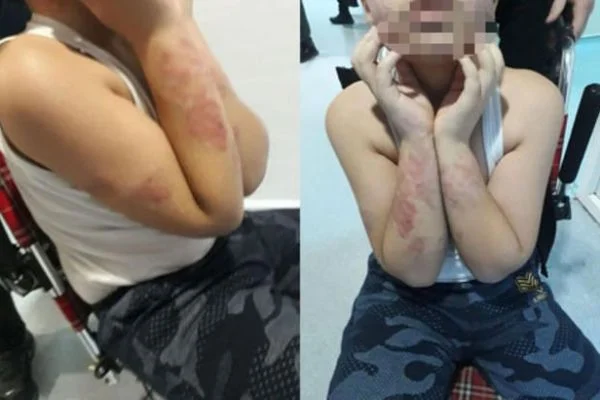 'İki kolunda ısırık izi gibi onlarca morluk vardı'