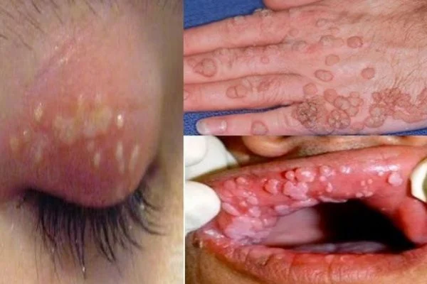 HPV virüs enfeksiyonlarından korunmanın tek yolu aşı