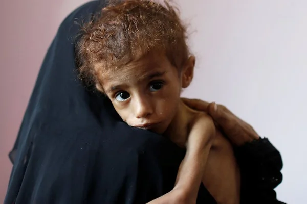 Yemen'de beş yılda 80 binden fazla çocuk açlıktan öldü