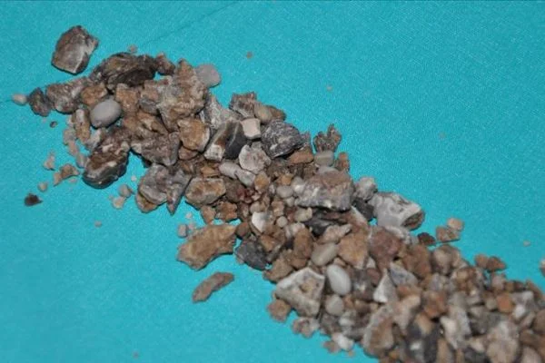 Böbreklerinden 'geyik boynuzu' şeklinde 500'den fazla taş çıktı