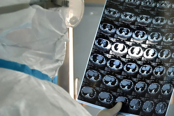 Koronavirüs akciğerde nasıl yayılıyor? İşte bir hastanın tomografi görüntüleri